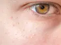 Nahaufnahme der Haut mit kleinen, hellen Erhebungen, die nicht komedogen sind. Das Auge ist im Hintergrund zu sehen.
