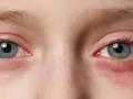Nahaufnahme der Augen eines Kindes mit geröteten, gereizten Augenlidern und einem leichten Ausschlag unterm Auge.