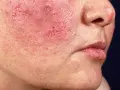 Nahaufnahme eines roten Gesichts mit entzündeten Stellen und Pusteln. Mögliche Ursachen für ein rotes Gesicht können vielfältig sein, auch die Leber spielt eine Rolle.