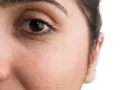 Nahaufnahme des Gesichts einer Frau mit kleinen weißen Milien unter dem Auge. Informationen zu Milien entfernen Hausmittel.