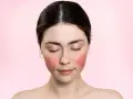 Rötungen im Gesicht, vielleicht eine retinol warnung? Die Haut ist gerötet, die Augen geschlossen.