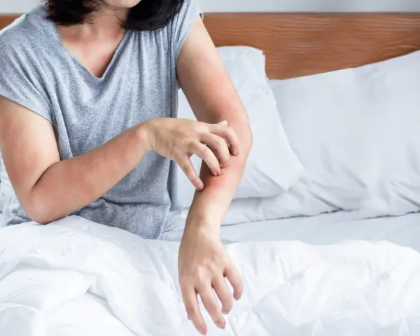 Frau kratzt sich am Arm, rote Hautstellen. Juckende Haut kann ein Symptom der Wechseljahre sein.