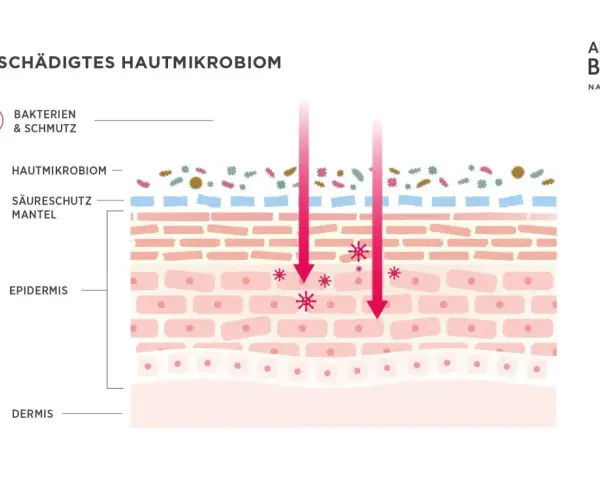 Illustration zeigt ein geschädigtes Hautmikrobiom mit Bakterien und Schmutz, die in die Epidermis eindringen.