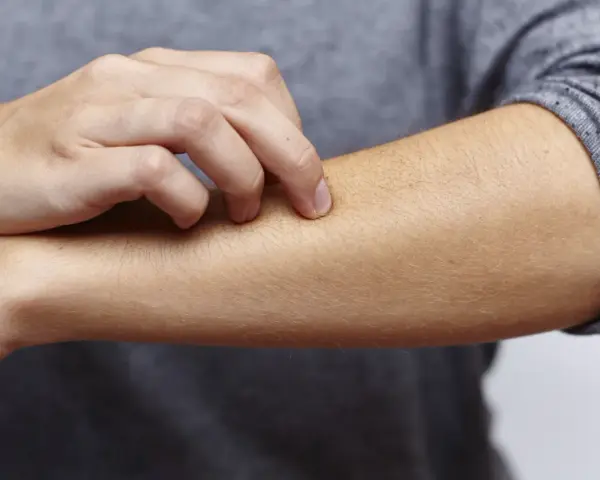 Juckende Haut am Arm, ein mögliches Symptom bei zu viel Zink.