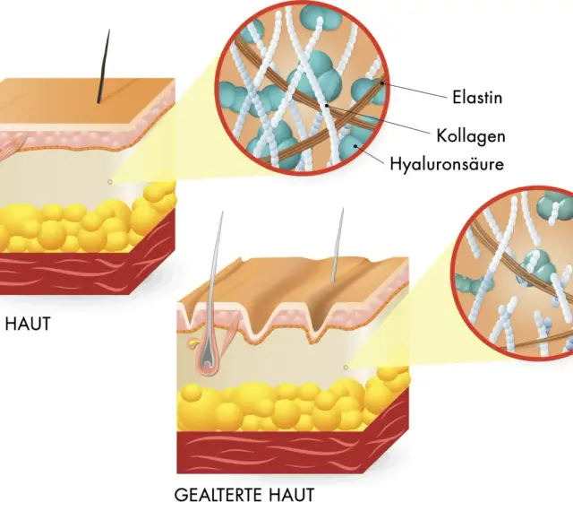 Vergleich von junger und gealterter Haut. Die kollagen wirkung wird durch die Darstellung von Elastin, Kollagen und Hyaluronsäure in den Hautschichten gezeigt.