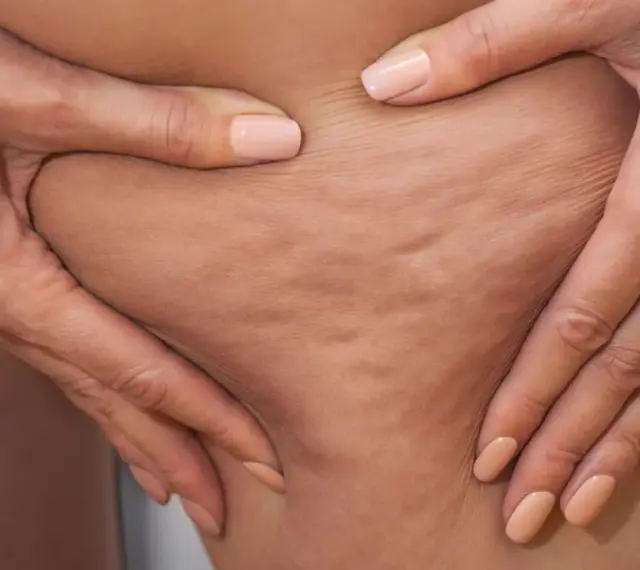 Hände greifen in die Haut an den Oberschenkeln, um Cellulite an den Beinen zu zeigen.