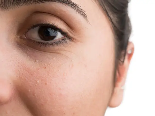 Nahaufnahme des Gesichts einer Frau mit kleinen weißen Milien unter dem Auge. Informationen zu Milien entfernen Hausmittel.