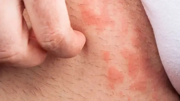 Haut mit roten Flecken und Haaren, die von einem Finger gekratzt werden. Backpulver gegen Juckreiz könnte Linderung verschaffen.