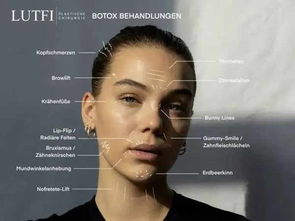 Gesicht einer Frau mit Markierungen für Botox-Behandlungen, die Stirnfalten und die falte zwischen den augen hervorheben.