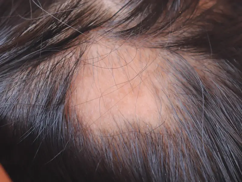 Hautbereich mit schütterem Haar, deutet auf seborrhoisches Ekzem hin. Rötliche, schuppige Stelle auf der Kopfhaut.