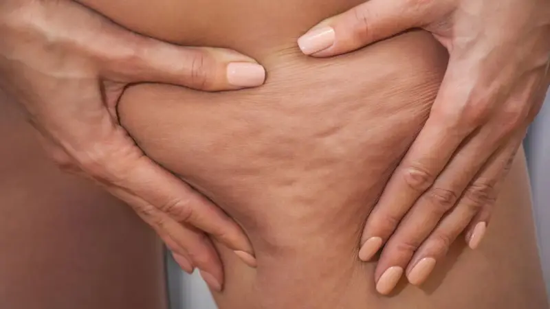 Hände greifen in die Haut an den Oberschenkeln, um Cellulite an den Beinen zu zeigen.